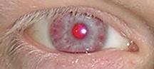 red-albino-eye